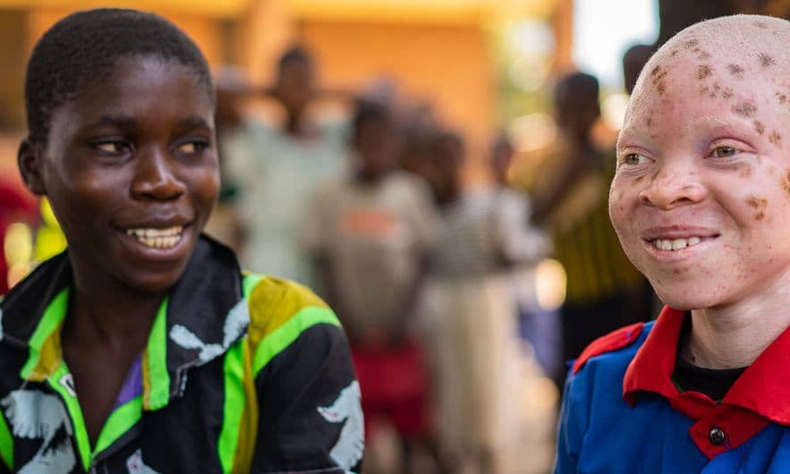 ‘Inclusion is strength’ stresses UN, marking Albinism Awareness Day