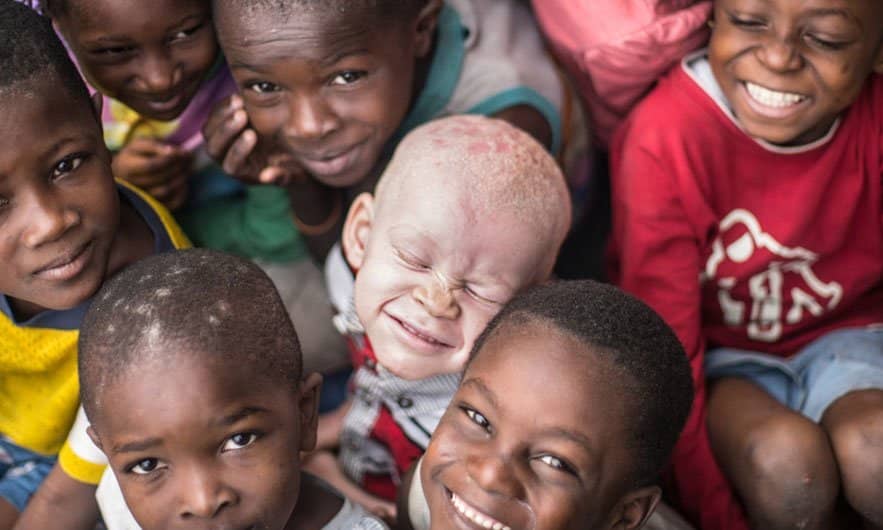 Recognize, celebrate and ‘stand in solidarity’ with persons with albinism